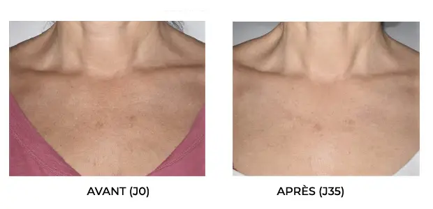 Masque Bodysculptor avant après