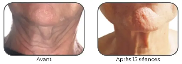 Masque Bodysculptor double menton avant après