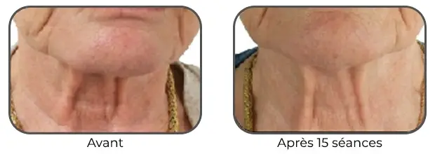 Masque Bodysculptor double menton avant après