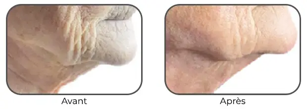 Masque Bodysculptor double menton avant après