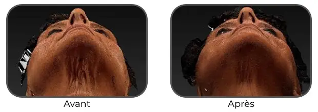 Masque Bodysculptor double menton avant après