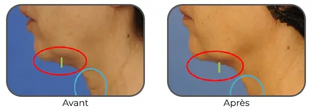 Masque Bodysculptor double menton avant après