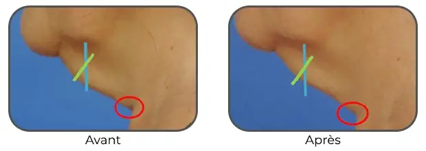 Masque Bodysculptor double menton avant après