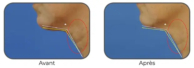 Masque Bodysculptor double menton avant après